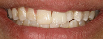 Before treatment with partial dentures