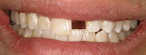 Before treatment with partial dentures