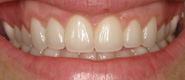 Teeth veneers after the procedure