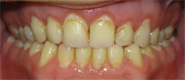 Before application of teeth veneers